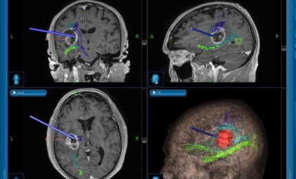 Caltanissetta, intervento neurochirurgico con l’aiuto della trattografia