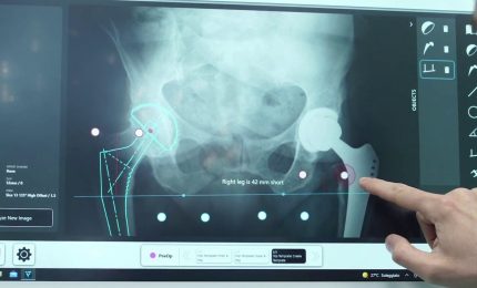 Humanitas, per le protesi d'anca un navigatore computerizzato