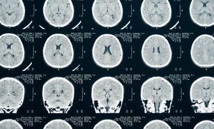 L'intelligenza artificiale per ottimizzare la Tac